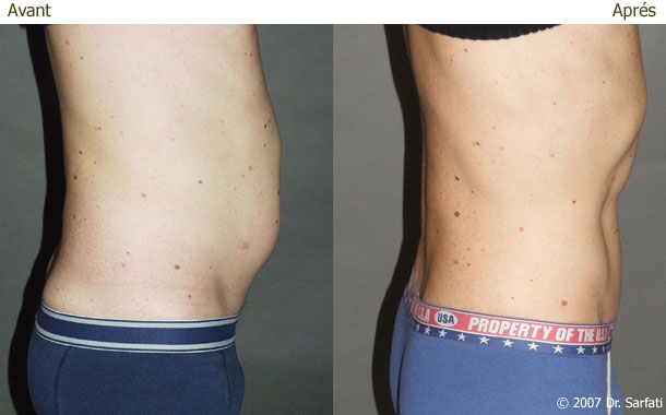 Lipocavitation (Ventre-Hanches)