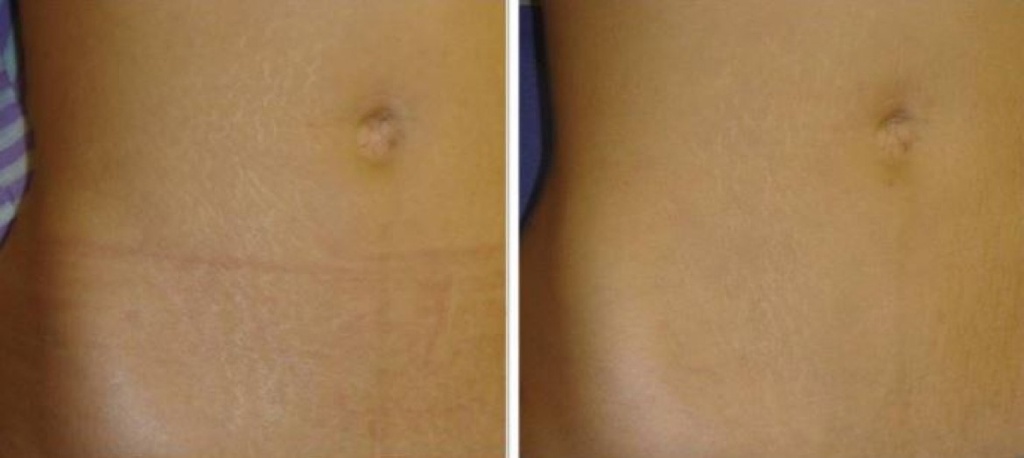 Epilation Ventre au Laser