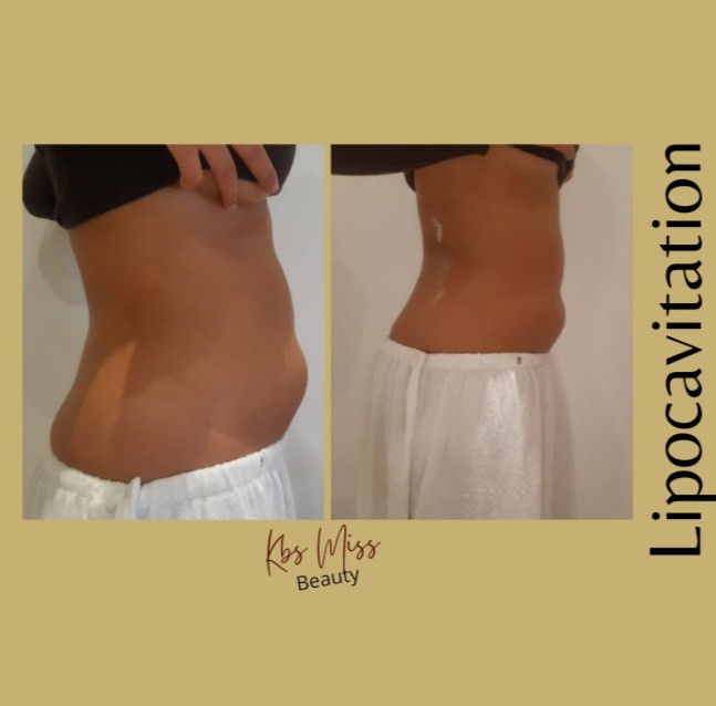 Lipocavitation (Ventre-Hanches-Bras)