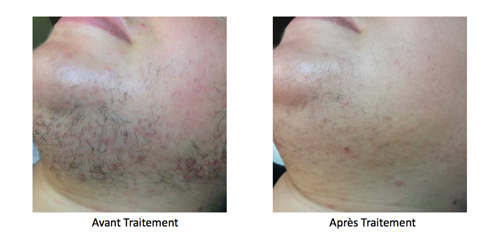 Epilation Cou au Laser