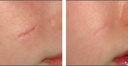 TRAITEMENT CICATRICE AU LASER