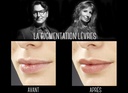 MICROPIGMENTATION DES LEVRES